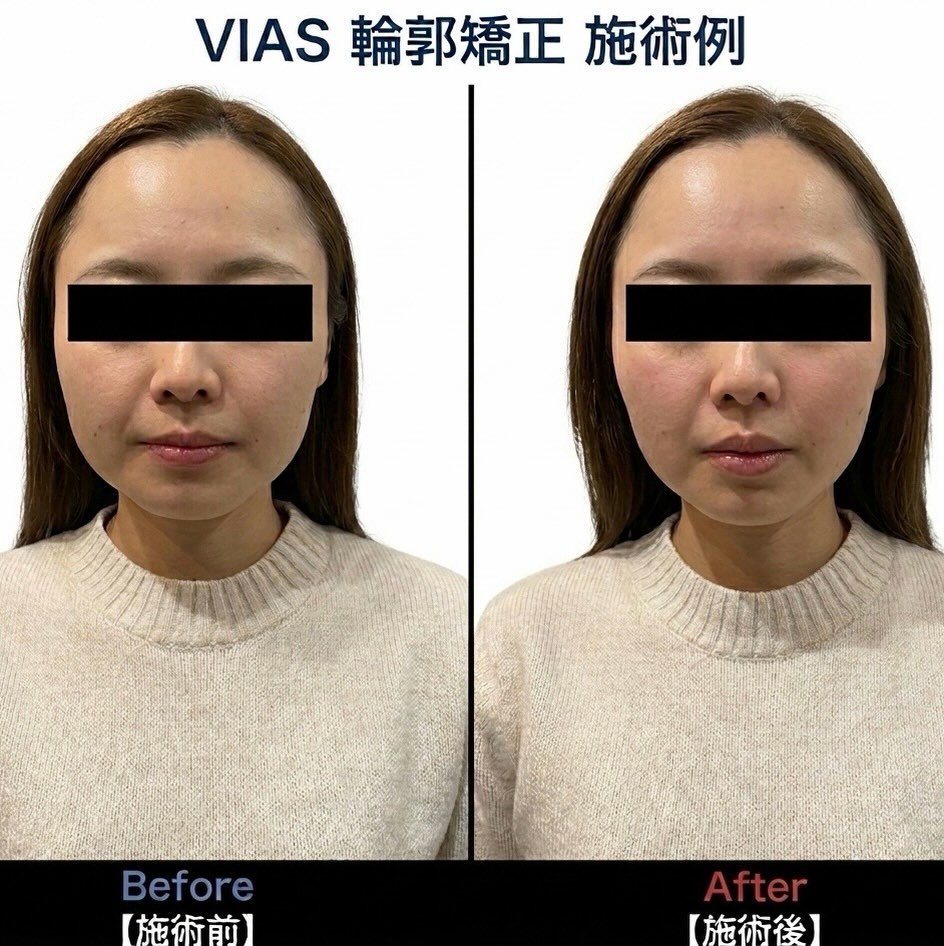 ✨️痛くない小顔矯正で、自分史上最高のフェイスラインへ✨️