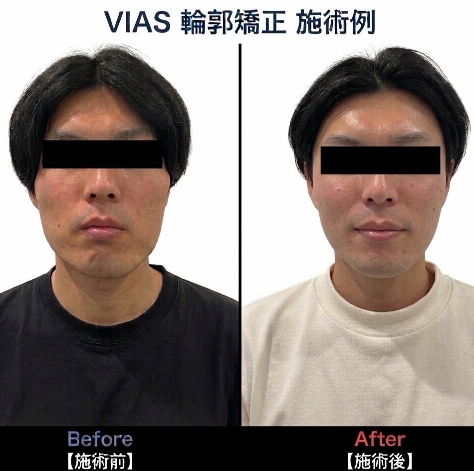 筋肉を整えて、シャープなフェイスラインへ‍♂️